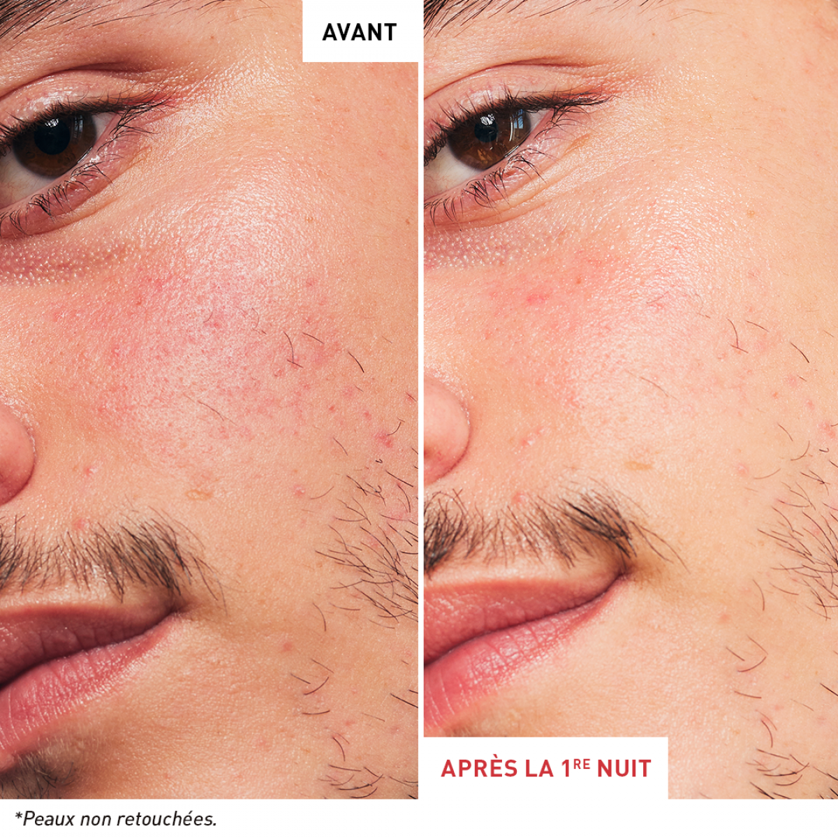 avant-apres-skin-fr-therapy-1